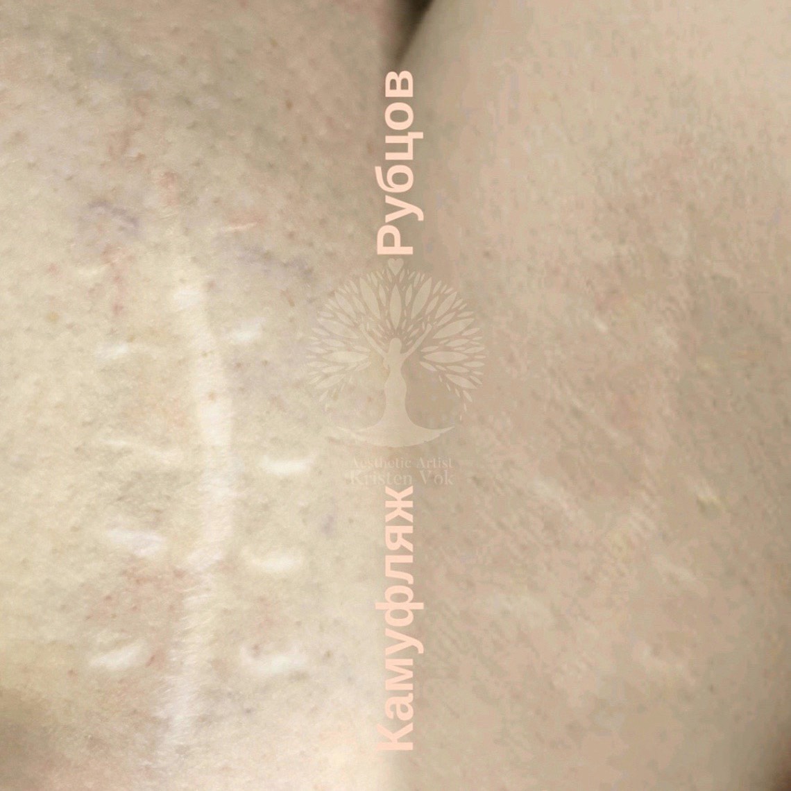 камуфляж шрамов, камуфляж рубцов +и шрамов