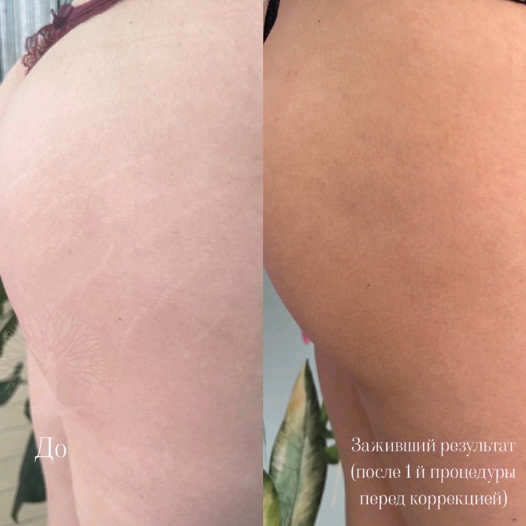 камуфляж шрамов, камуфляж рубцов +и шрамов