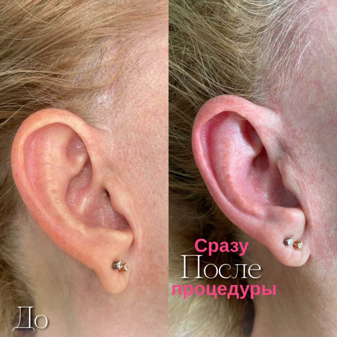 камуфляж шрамов, камуфляж рубцов +и шрамов