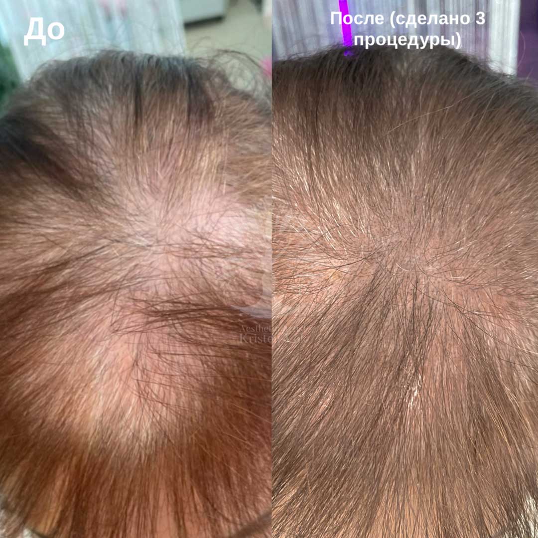 трихопигментация волос в Минске