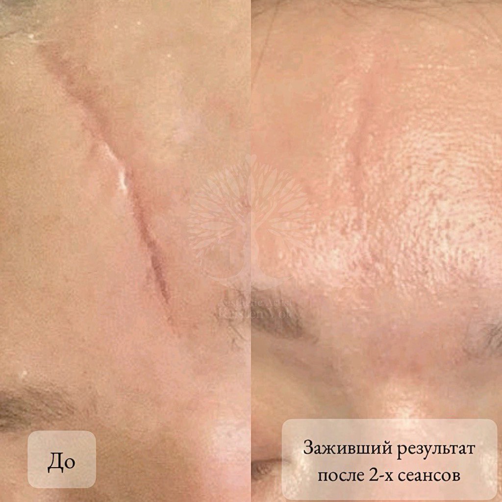 камуфляж шрамов, камуфляж рубцов +и шрамов