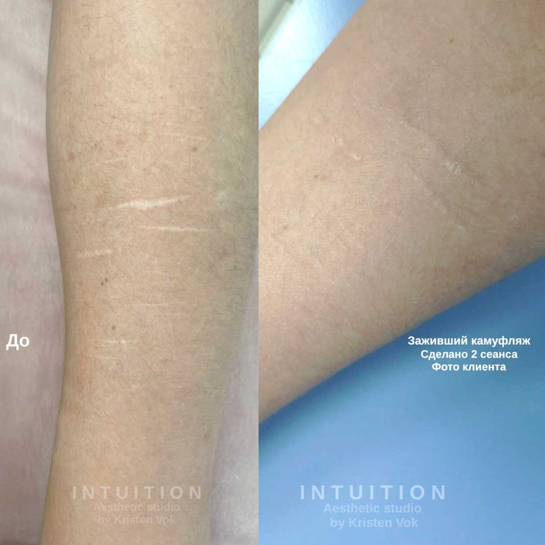 камуфляж шрамов, камуфляж рубцов +и шрамов