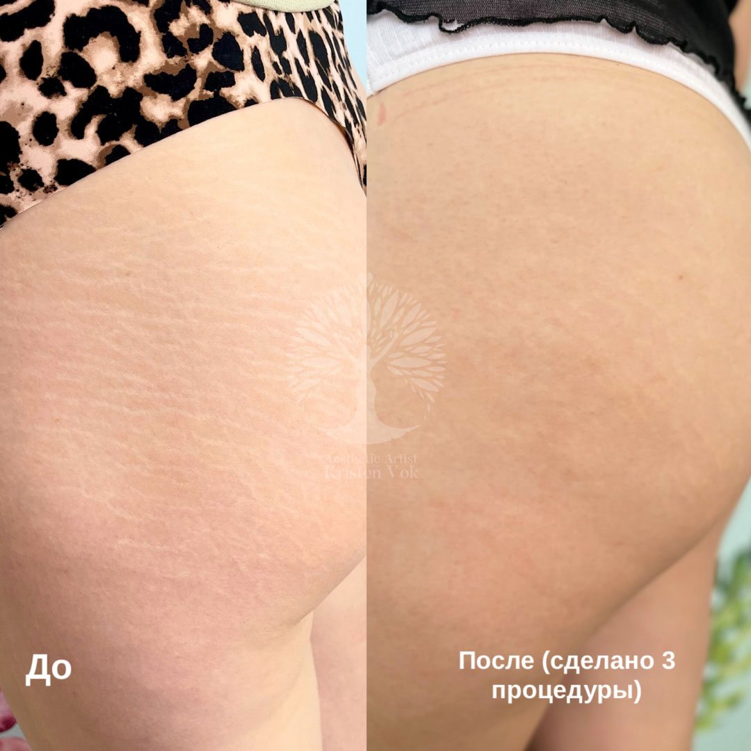 камуфляж шрамов, камуфляж рубцов +и шрамов