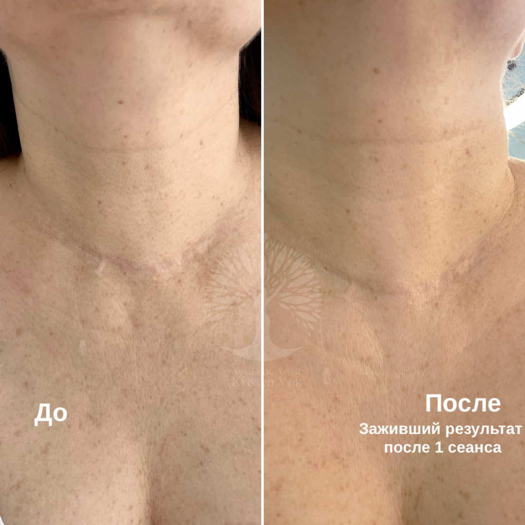 камуфляж шрамов, камуфляж рубцов +и шрамов