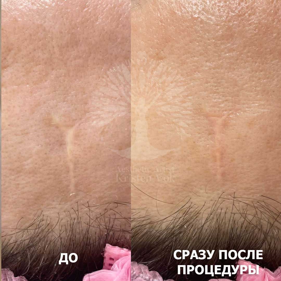 камуфляж шрамов, камуфляж рубцов +и шрамов