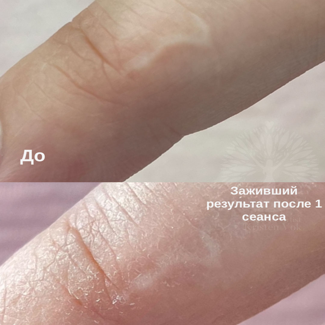 камуфляж шрамов, камуфляж рубцов +и шрамов