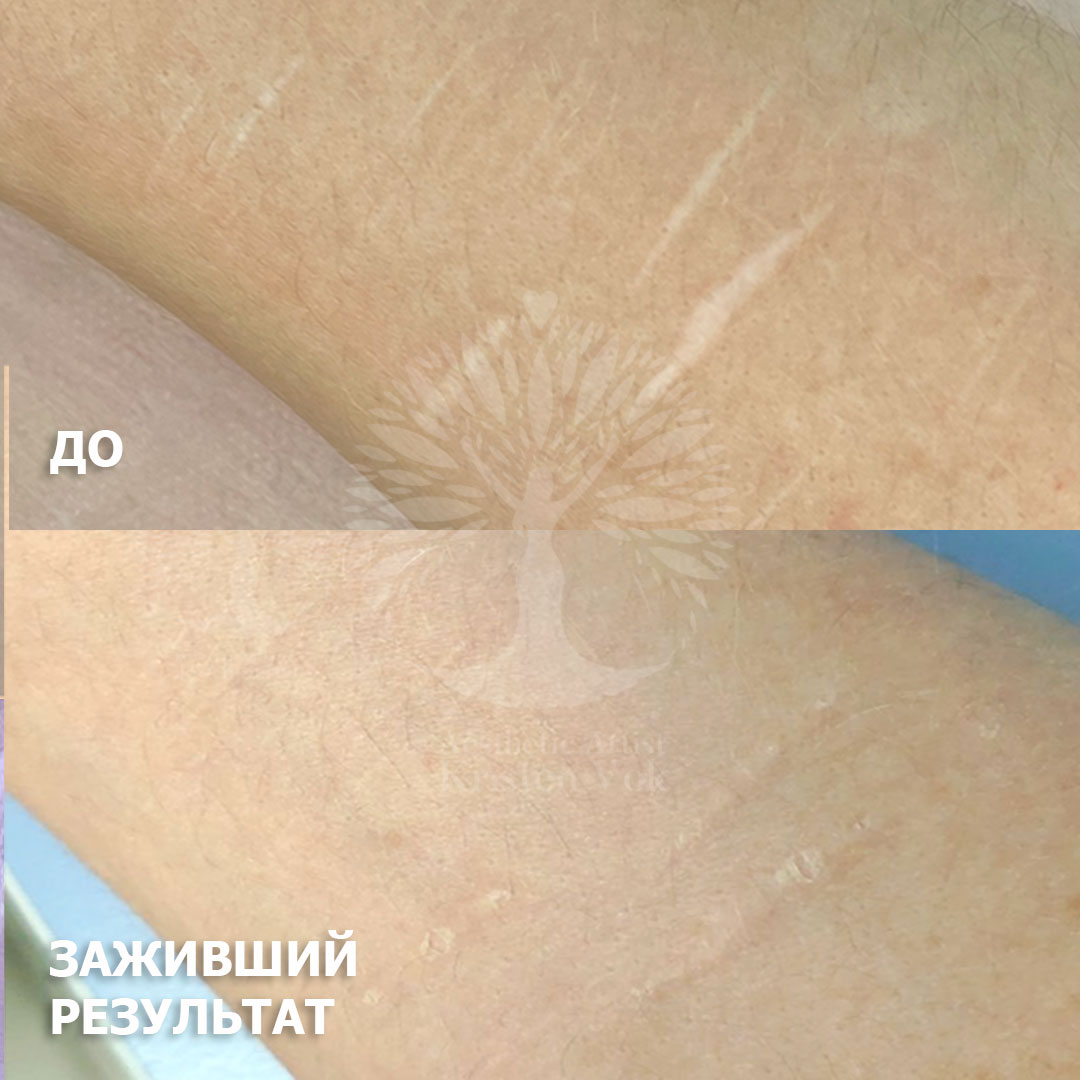 камуфляж шрамов, камуфляж рубцов +и шрамов