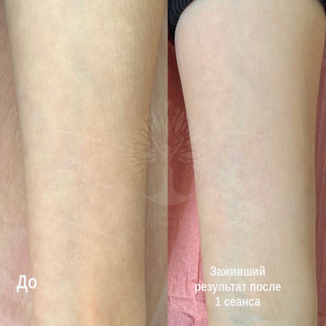 камуфляж шрамов, камуфляж рубцов +и шрамов