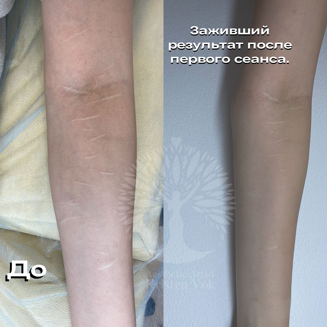 камуфляж шрамов, камуфляж рубцов +и шрамов