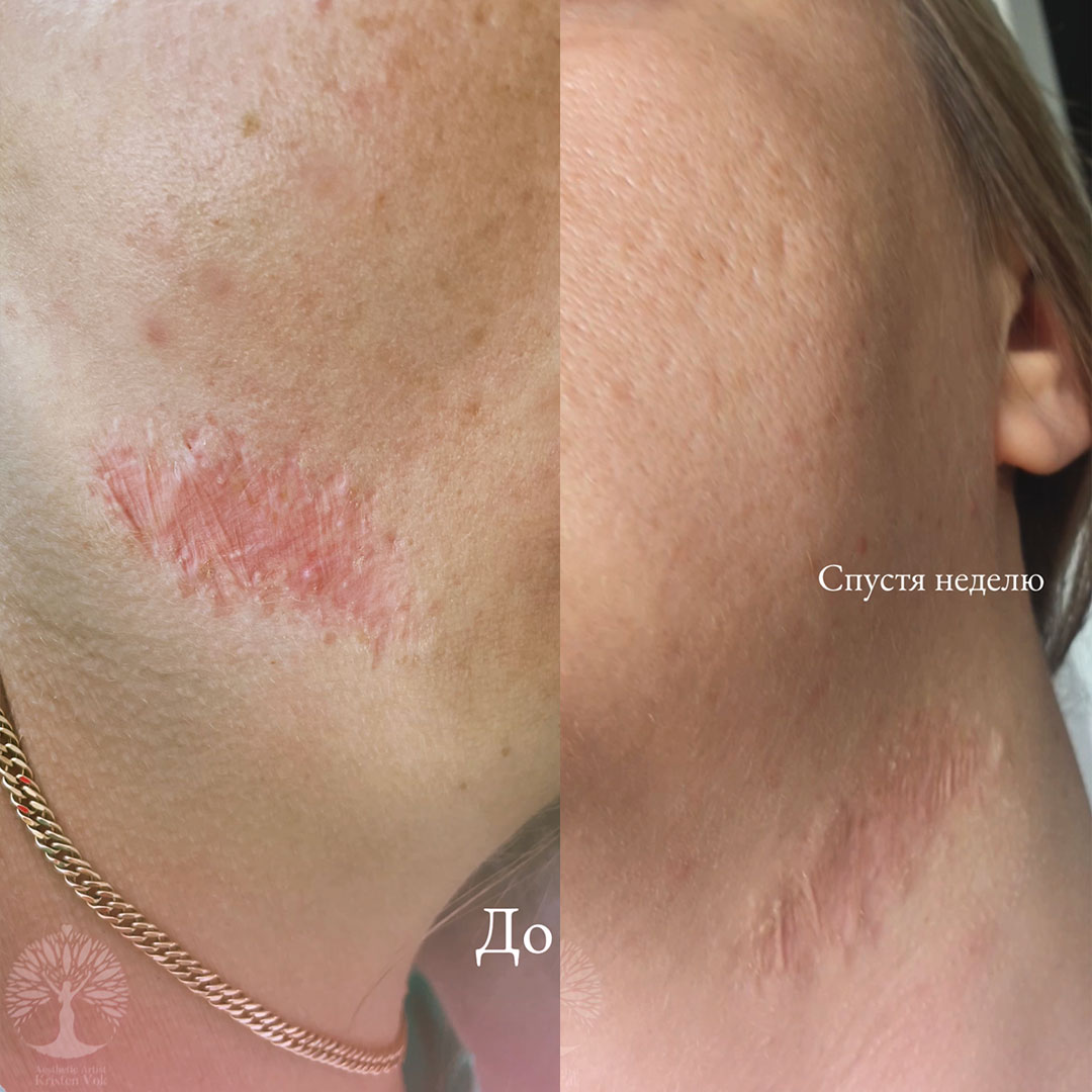 камуфляж шрамов, камуфляж рубцов +и шрамов