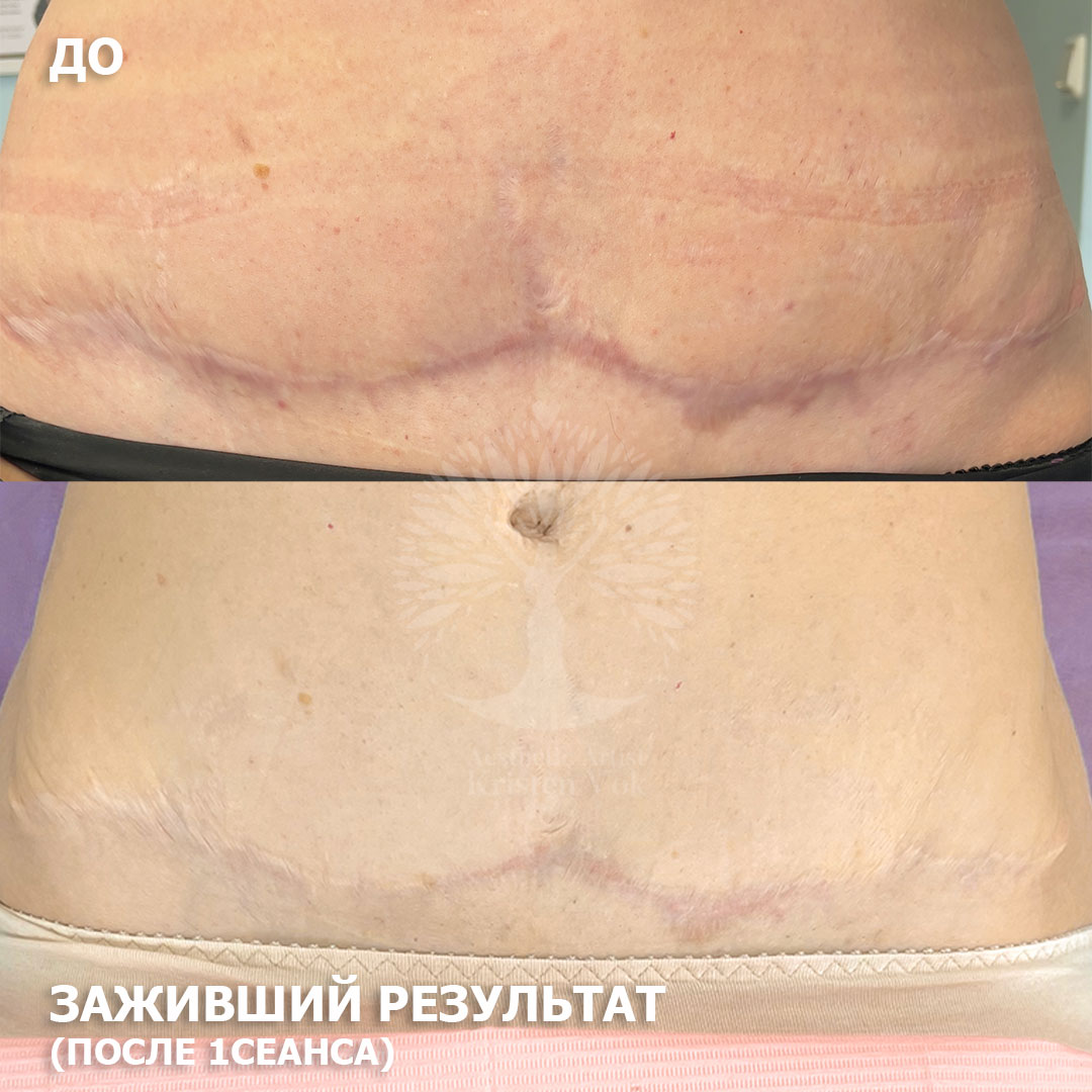 камуфляж шрамов, камуфляж рубцов +и шрамов