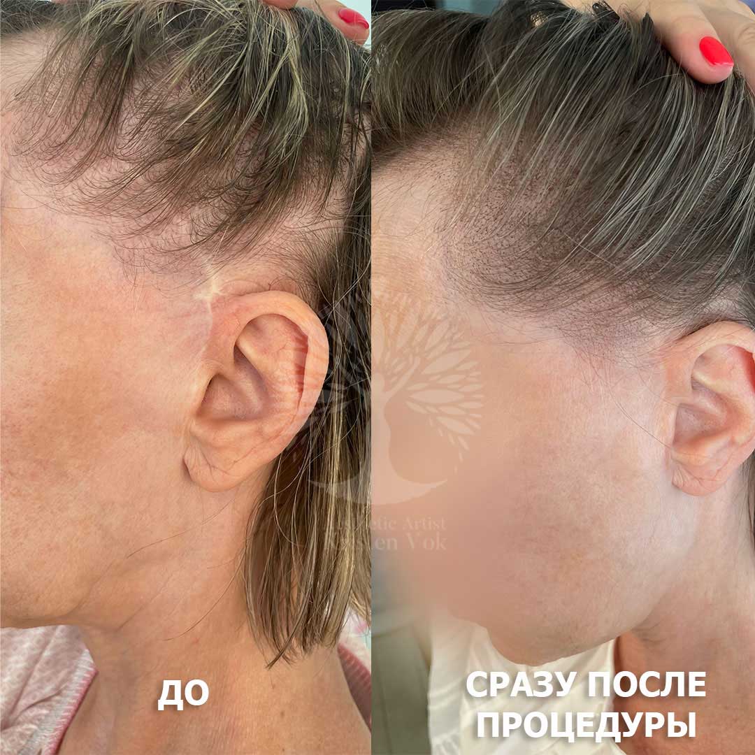 трихопигментация волос в Минске