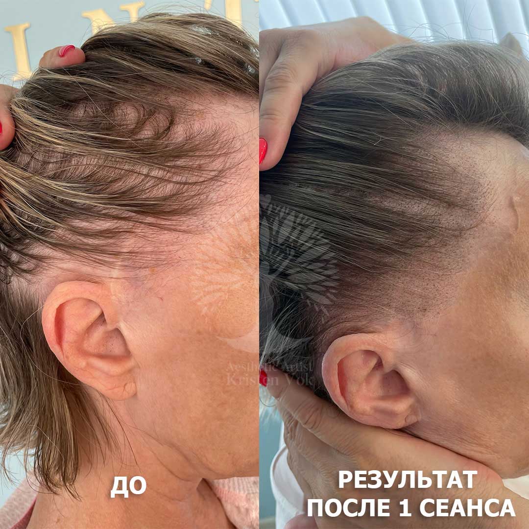 трихопигментация волос в Минске