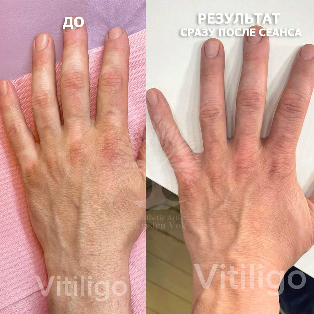 камуфляж шрамов, камуфляж рубцов +и шрамов