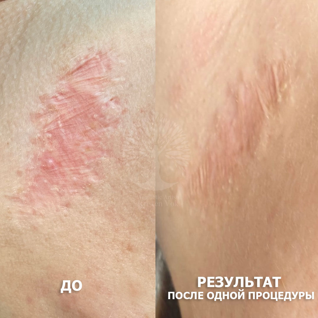 камуфляж шрамов, камуфляж рубцов +и шрамов