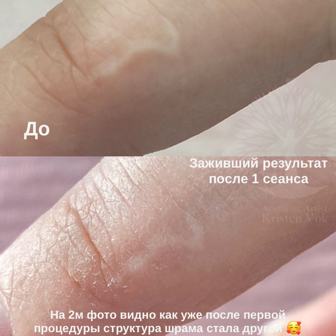 камуфляж шрамов, камуфляж рубцов +и шрамов