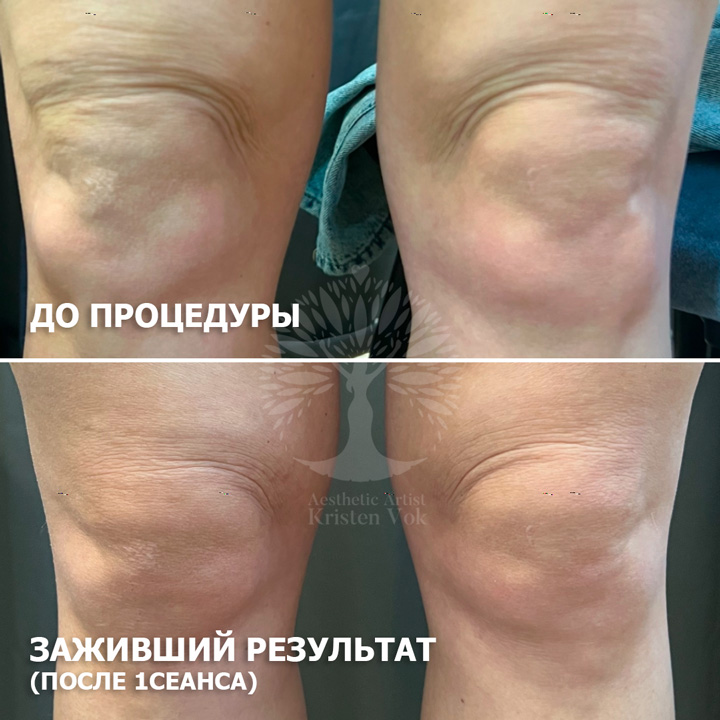 холодная плазма, холодная плазма цена, холодная плазам головы, холодная п отзывы, холодная плазма волос женщины, холодная плазма стоимость, холодная плазма кожи головы, холодная плазма, холодная плазма в Беларуси, холодная плазма Минск, холодная плазма отзывы