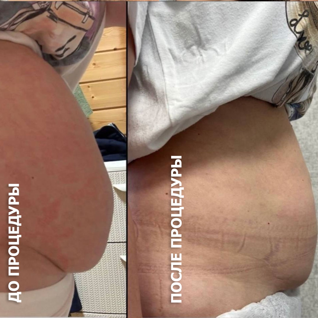 холодная плазма, холодная плазма цена, холодная плазам головы, холодная п отзывы, холодная плазма волос женщины, холодная плазма стоимость, холодная плазма кожи головы, холодная плазма, холодная плазма в Беларуси, холодная плазма Минск, холодная плазма отзывы