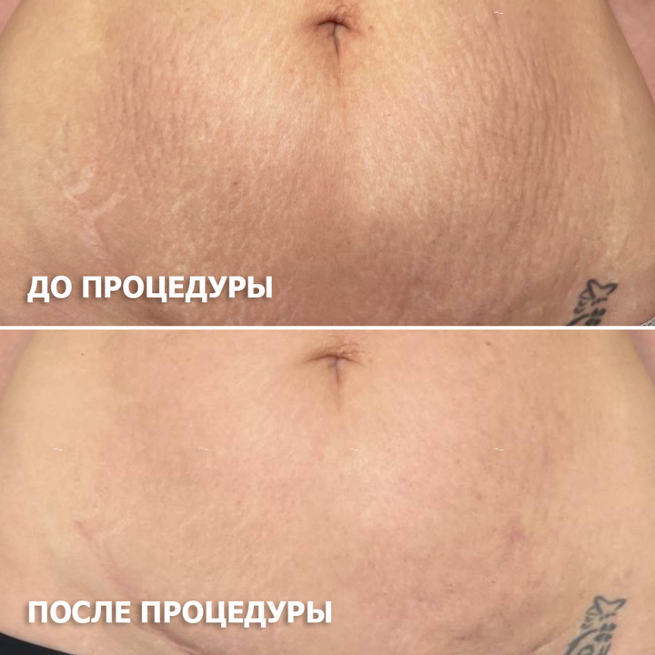 холодная плазма, холодная плазма цена, холодная плазам головы, холодная п отзывы, холодная плазма волос женщины, холодная плазма стоимость, холодная плазма кожи головы, холодная плазма, холодная плазма в Беларуси, холодная плазма Минск, холодная плазма отзывы