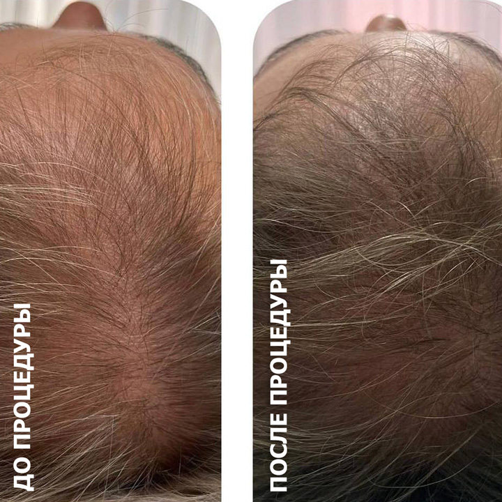 холодная плазма, холодная плазма цена, холодная плазам головы, холодная п отзывы, холодная плазма волос женщины, холодная плазма стоимость, холодная плазма кожи головы, холодная плазма, холодная плазма в Беларуси, холодная плазма Минск, холодная плазма отзывы