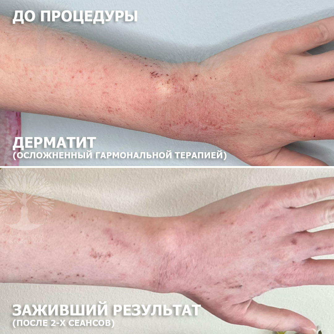 холодная плазма, холодная плазма цена, холодная плазам головы, холодная п отзывы, холодная плазма волос женщины, холодная плазма стоимость, холодная плазма кожи головы, холодная плазма, холодная плазма в Беларуси, холодная плазма Минск, холодная плазма отзывы