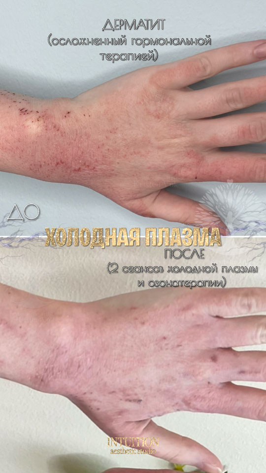 холодная плазма, холодная плазма цена, холодная плазам головы, холодная п отзывы, холодная плазма волос женщины, холодная плазма стоимость, холодная плазма кожи головы, холодная плазма, холодная плазма в Беларуси, холодная плазма Минск, холодная плазма отзывы