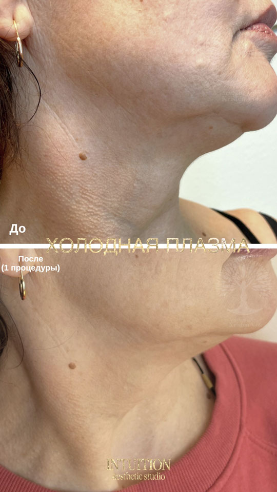 холодная плазма, холодная плазма цена, холодная плазам головы, холодная п отзывы, холодная плазма волос женщины, холодная плазма стоимость, холодная плазма кожи головы, холодная плазма, холодная плазма в Беларуси, холодная плазма Минск, холодная плазма отзывы