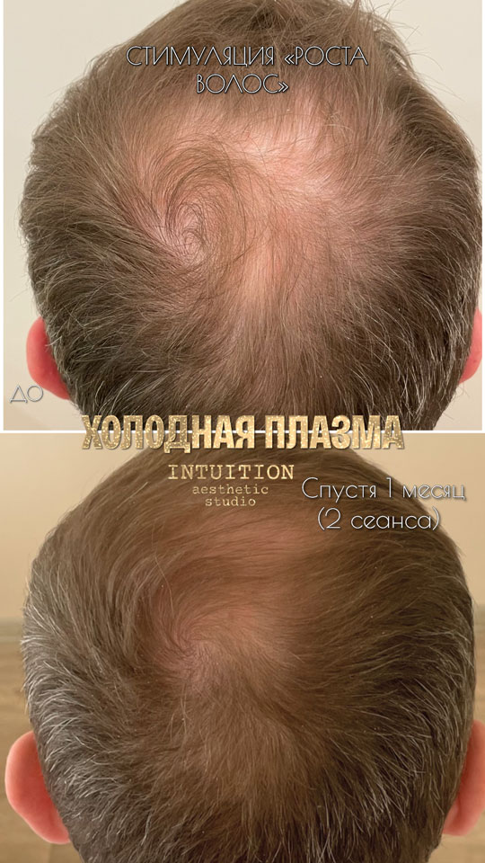 холодная плазма, холодная плазма цена, холодная плазам головы, холодная п отзывы, холодная плазма волос женщины, холодная плазма стоимость, холодная плазма кожи головы, холодная плазма, холодная плазма в Беларуси, холодная плазма Минск, холодная плазма отзывы