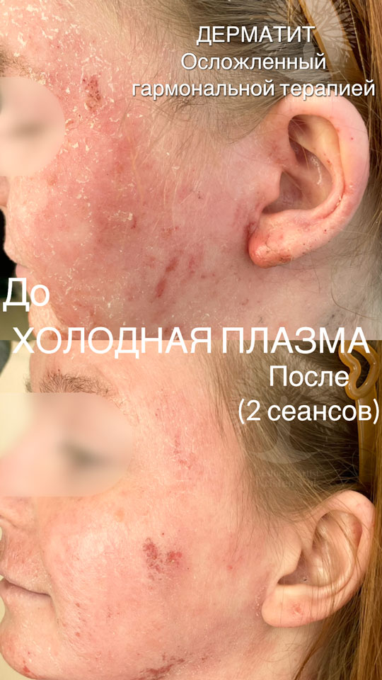 холодная плазма, холодная плазма цена, холодная плазам головы, холодная п отзывы, холодная плазма волос женщины, холодная плазма стоимость, холодная плазма кожи головы, холодная плазма, холодная плазма в Беларуси, холодная плазма Минск, холодная плазма отзывы