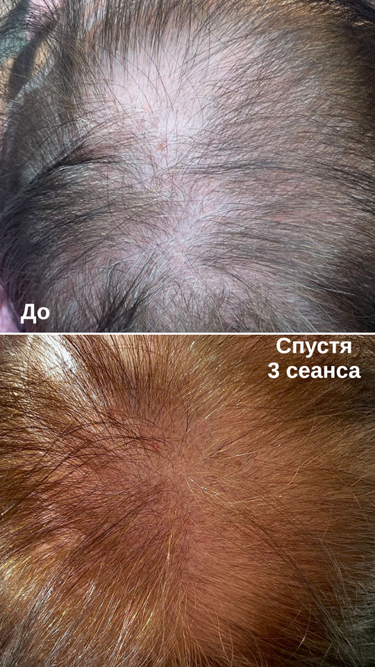 холодная плазма, холодная плазма цена, холодная плазам головы, холодная п отзывы, холодная плазма волос женщины, холодная плазма стоимость, холодная плазма кожи головы, холодная плазма, холодная плазма в Беларуси, холодная плазма Минск, холодная плазма отзывы