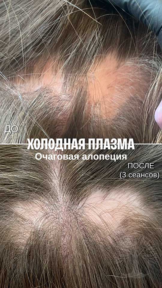 холодная плазма, холодная плазма цена, холодная плазам головы, холодная п отзывы, холодная плазма волос женщины, холодная плазма стоимость, холодная плазма кожи головы, холодная плазма, холодная плазма в Беларуси, холодная плазма Минск, холодная плазма отзывы