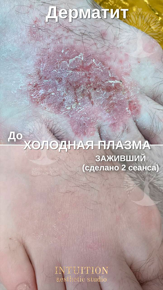 холодная плазма, холодная плазма цена, холодная плазам головы, холодная п отзывы, холодная плазма волос женщины, холодная плазма стоимость, холодная плазма кожи головы, холодная плазма, холодная плазма в Беларуси, холодная плазма Минск, холодная плазма отзывы