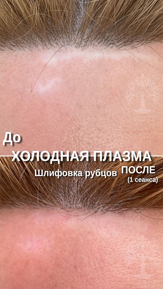 холодная плазма, холодная плазма цена, холодная плазам головы, холодная п отзывы, холодная плазма волос женщины, холодная плазма стоимость, холодная плазма кожи головы, холодная плазма, холодная плазма в Беларуси, холодная плазма Минск, холодная плазма отзывы