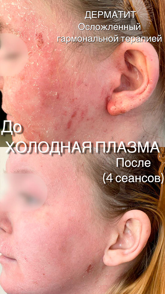 холодная плазма, холодная плазма цена, холодная плазам головы, холодная п отзывы, холодная плазма волос женщины, холодная плазма стоимость, холодная плазма кожи головы, холодная плазма, холодная плазма в Беларуси, холодная плазма Минск, холодная плазма отзывы