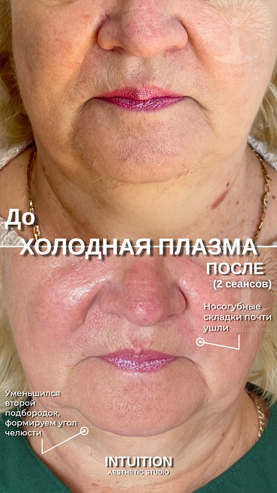 холодная плазма, холодная плазма цена, холодная плазам головы, холодная п отзывы, холодная плазма волос женщины, холодная плазма стоимость, холодная плазма кожи головы, холодная плазма, холодная плазма в Беларуси, холодная плазма Минск, холодная плазма отзывы