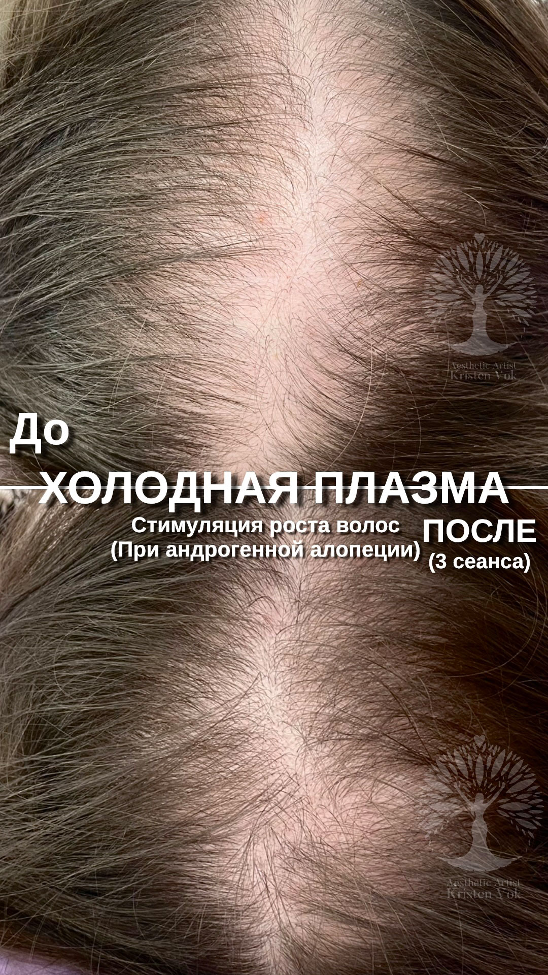 холодная плазма, холодная плазма цена, холодная плазам головы, холодная п отзывы, холодная плазма волос женщины, холодная плазма стоимость, холодная плазма кожи головы, холодная плазма, холодная плазма в Беларуси, холодная плазма Минск, холодная плазма отзывы