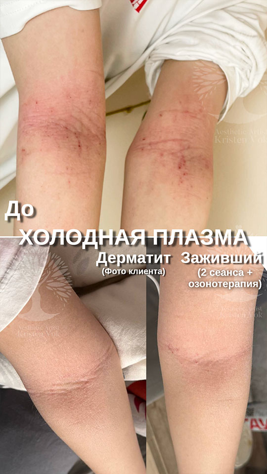 холодная плазма, холодная плазма цена, холодная плазам головы, холодная п отзывы, холодная плазма волос женщины, холодная плазма стоимость, холодная плазма кожи головы, холодная плазма, холодная плазма в Беларуси, холодная плазма Минск, холодная плазма отзывы