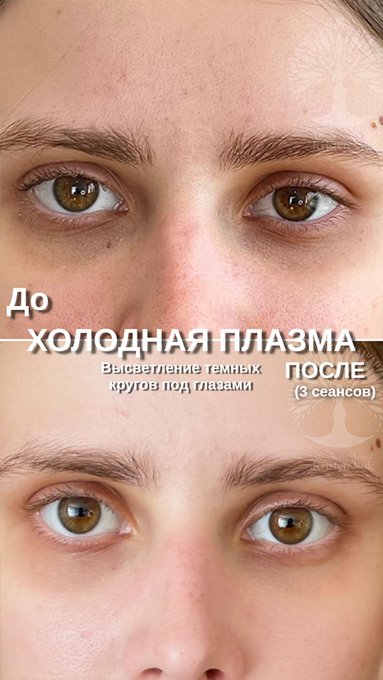 холодная плазма, холодная плазма цена, холодная плазам головы, холодная п отзывы, холодная плазма волос женщины, холодная плазма стоимость, холодная плазма кожи головы, холодная плазма, холодная плазма в Беларуси, холодная плазма Минск, холодная плазма отзывы