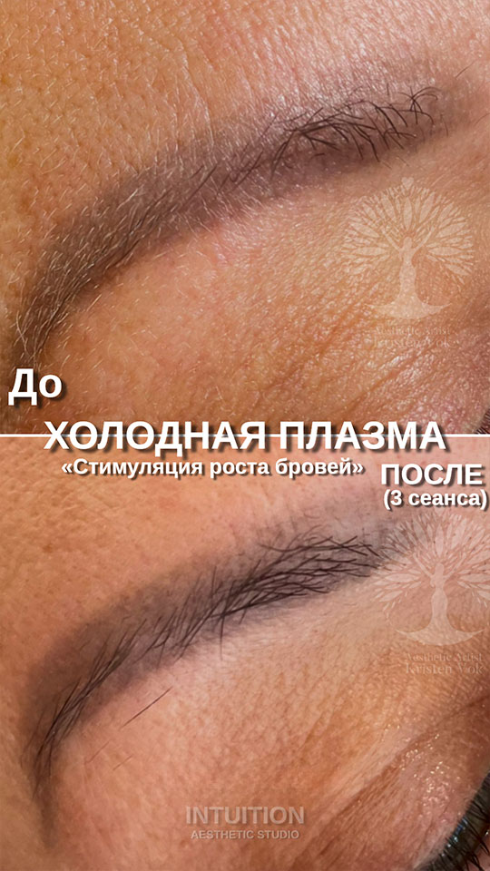 холодная плазма, холодная плазма цена, холодная плазам головы, холодная п отзывы, холодная плазма волос женщины, холодная плазма стоимость, холодная плазма кожи головы, холодная плазма, холодная плазма в Беларуси, холодная плазма Минск, холодная плазма отзывы