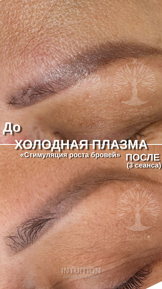 холодная плазма, холодная плазма цена, холодная плазам головы, холодная п отзывы, холодная плазма волос женщины, холодная плазма стоимость, холодная плазма кожи головы, холодная плазма, холодная плазма в Беларуси, холодная плазма Минск, холодная плазма отзывы