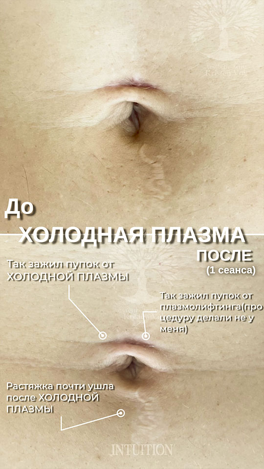 холодная плазма, холодная плазма цена, холодная плазам головы, холодная п отзывы, холодная плазма волос женщины, холодная плазма стоимость, холодная плазма кожи головы, холодная плазма, холодная плазма в Беларуси, холодная плазма Минск, холодная плазма отзывы