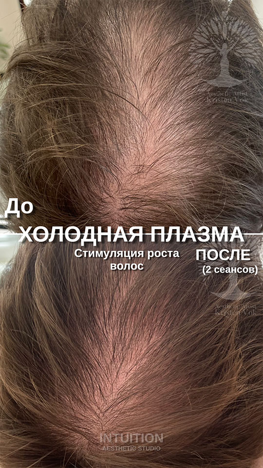 холодная плазма, холодная плазма цена, холодная плазам головы, холодная п отзывы, холодная плазма волос женщины, холодная плазма стоимость, холодная плазма кожи головы, холодная плазма, холодная плазма в Беларуси, холодная плазма Минск, холодная плазма отзывы