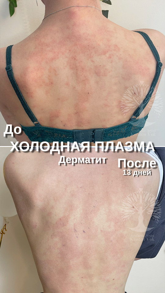 холодная плазма, холодная плазма цена, холодная плазам головы, холодная п отзывы, холодная плазма волос женщины, холодная плазма стоимость, холодная плазма кожи головы, холодная плазма, холодная плазма в Беларуси, холодная плазма Минск, холодная плазма отзывы