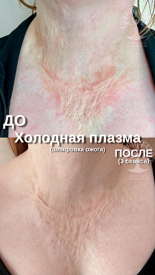 холодная плазма, холодная плазма цена, холодная плазам головы, холодная п отзывы, холодная плазма волос женщины, холодная плазма стоимость, холодная плазма кожи головы, холодная плазма, холодная плазма в Беларуси, холодная плазма Минск, холодная плазма отзывы