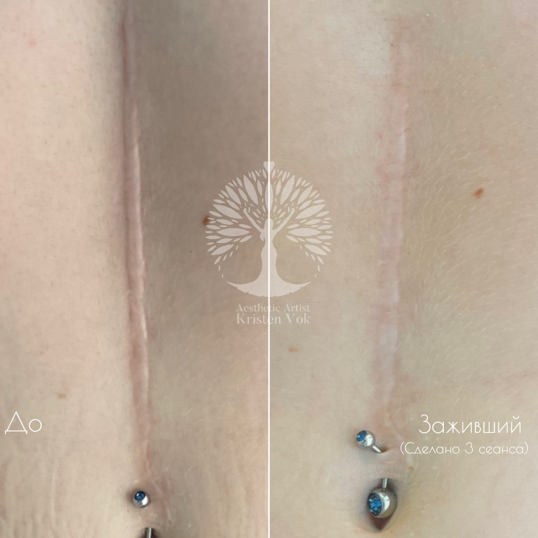 коллагенотерапия, + в минске, убрать шрамы, скрыть шрамы