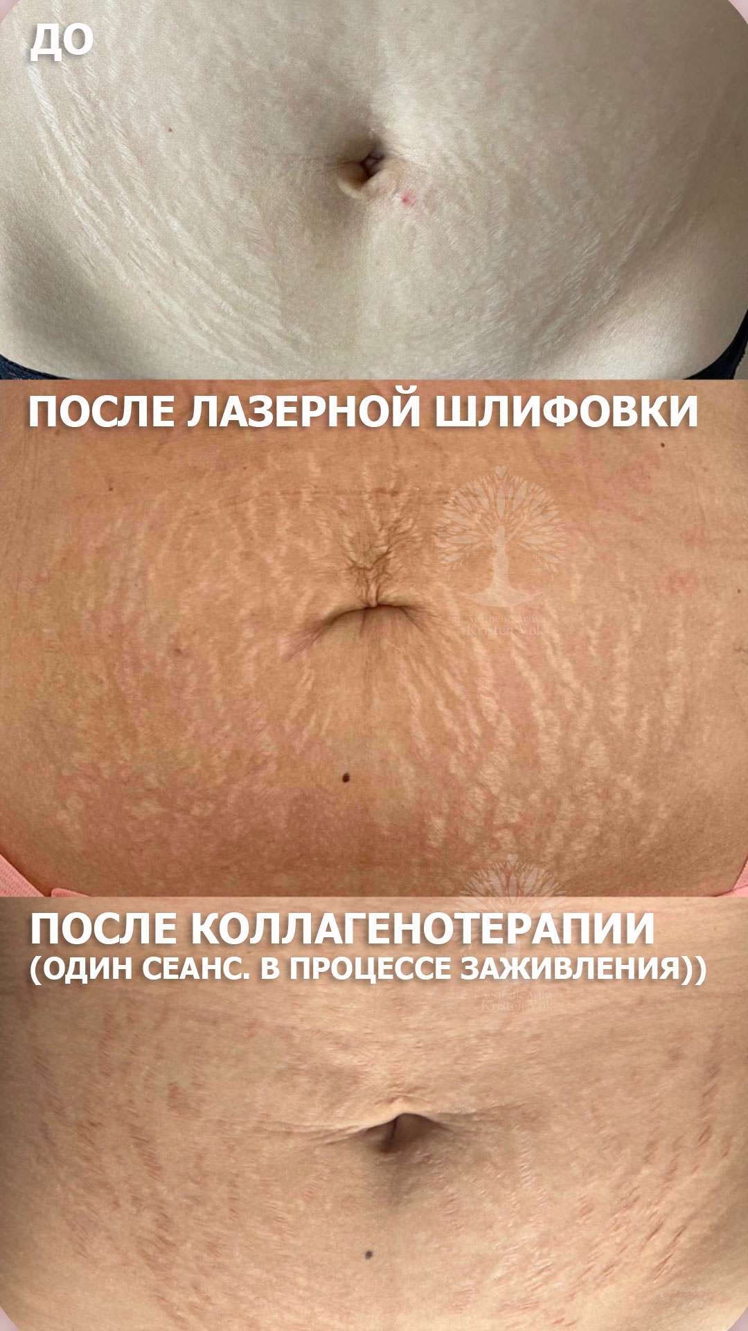 коллагенотерапия, + в минске, убрать шрамы, скрыть шрамы