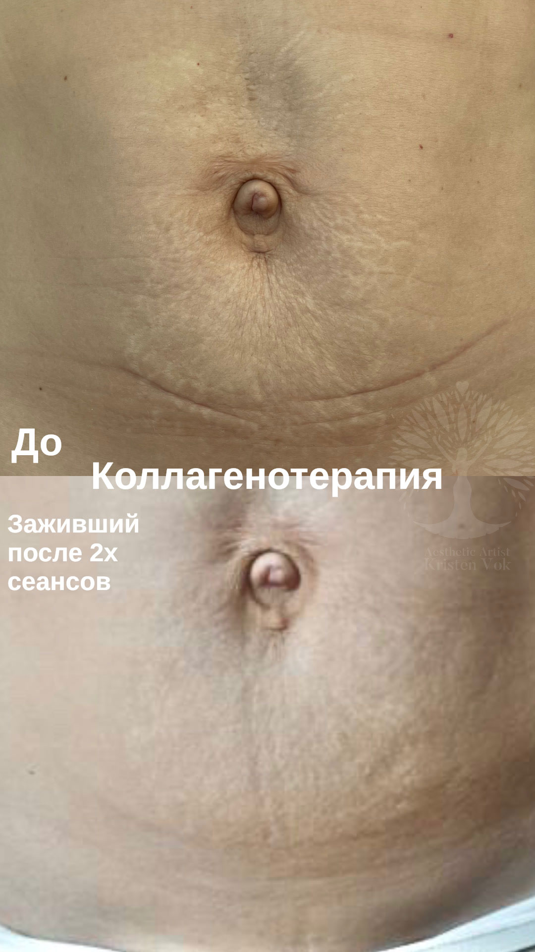 коллагенотерапия, + в минске, убрать шрамы, скрыть шрамы