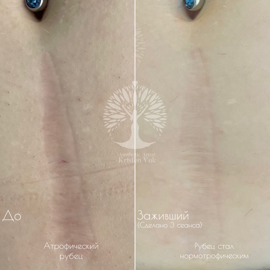 коллагенотерапия, + в минске, убрать шрамы, скрыть шрамы