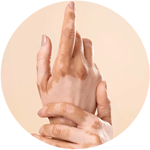 камуфляж витилиго в Минске