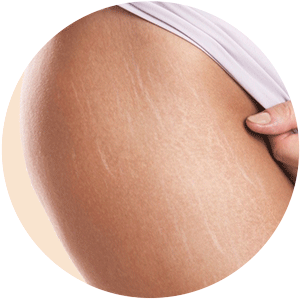 камуфляж шрамов рубцов растяжке в Минске